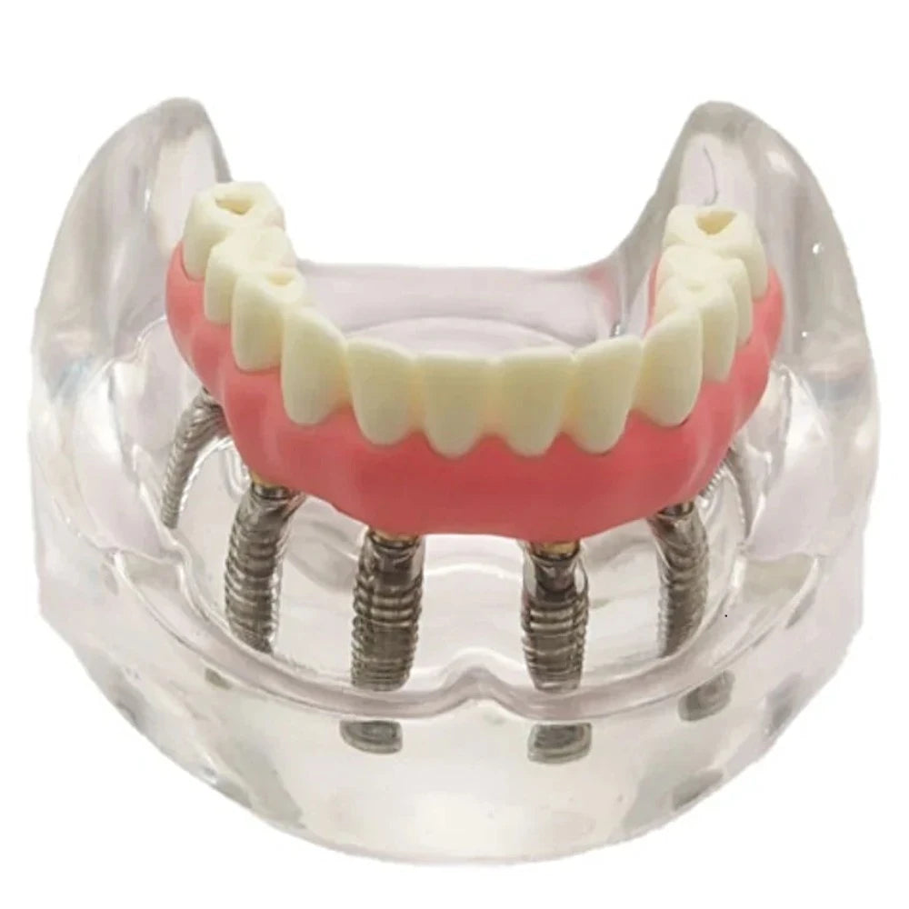 Malone Bridge 6 Implants - Dental Mates