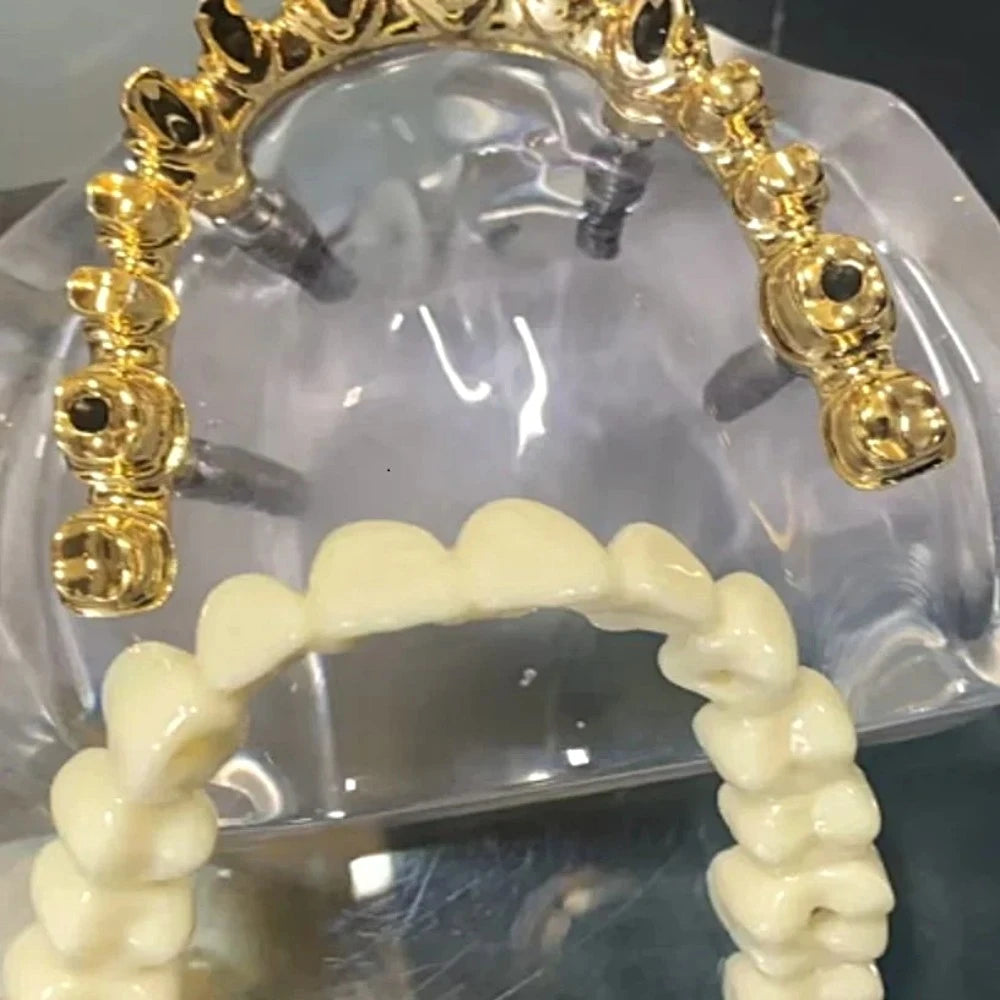 Aesthetic Bridge 4 Implants - Dental Mates