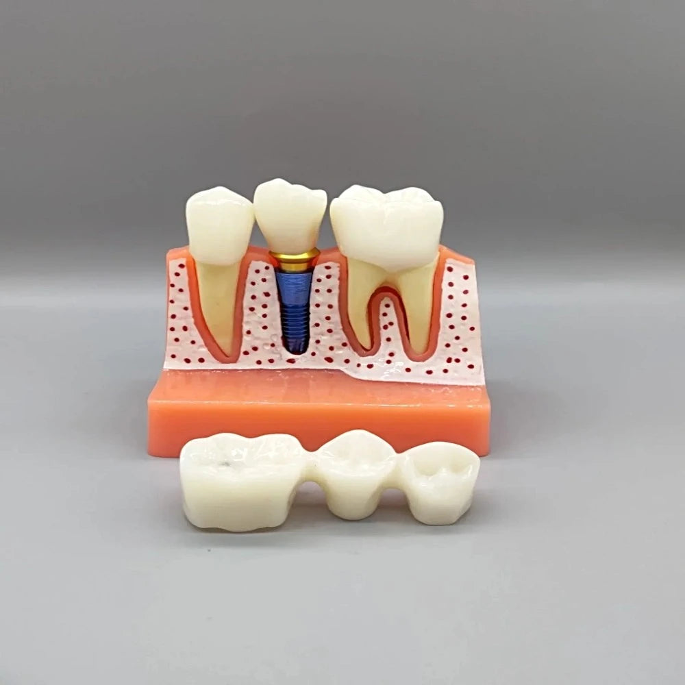 Dental Implant Educational Model - Dental Mates
