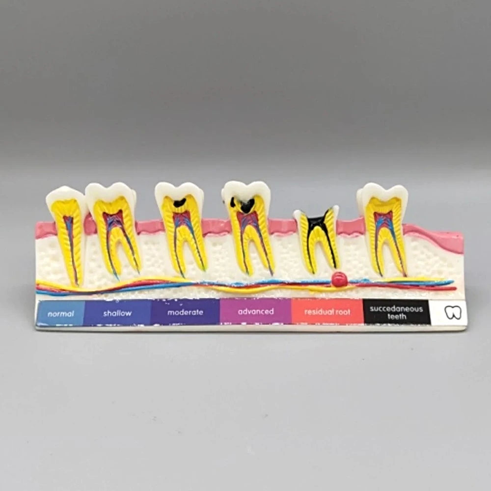 Tooth Caries Model - Dental Mates