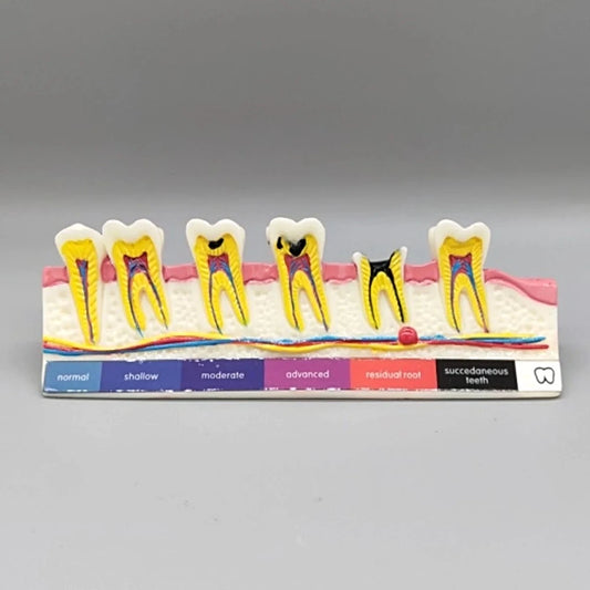 Tooth Caries Model - Dental Mates