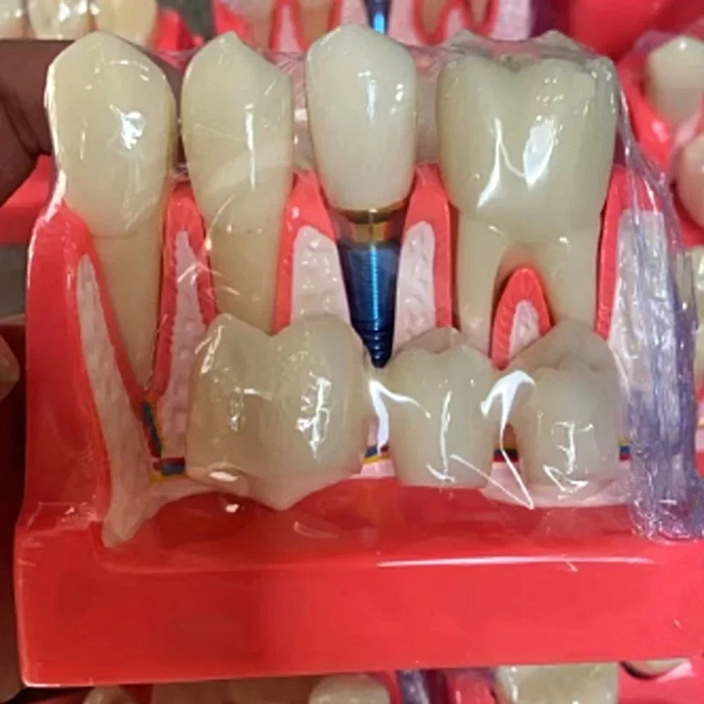 Veneer Dental Implant Model - Dental Mates