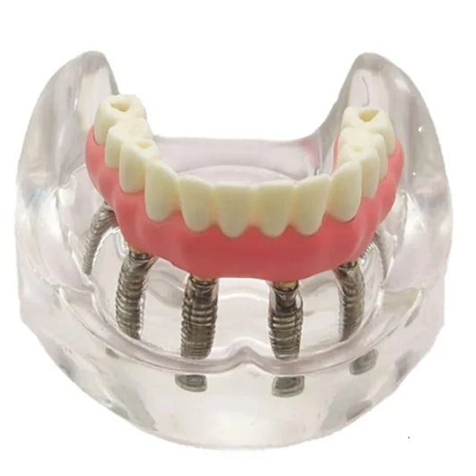 Malone Bridge 4 Implants - Dental Mates