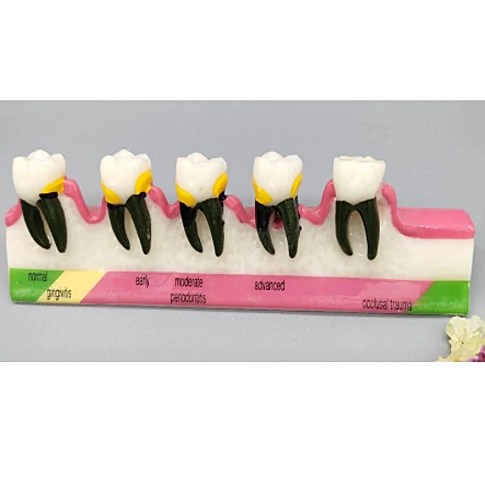 Periodontal Disease Model - Dental Mates