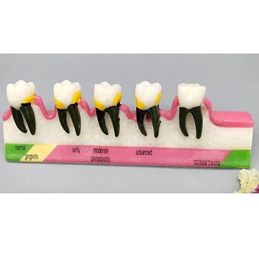Periodontal Disease Model - Dental Mates