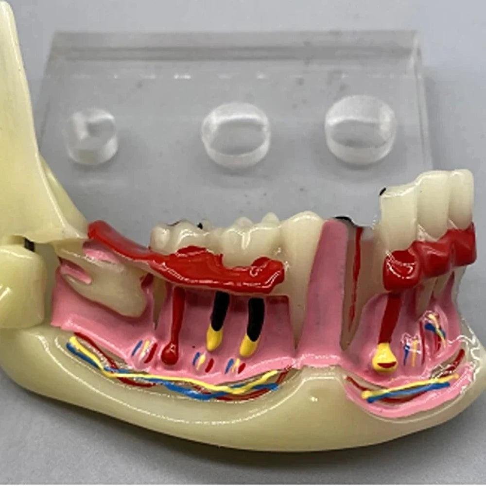 Mandibular Pathological Model - Dental Mates