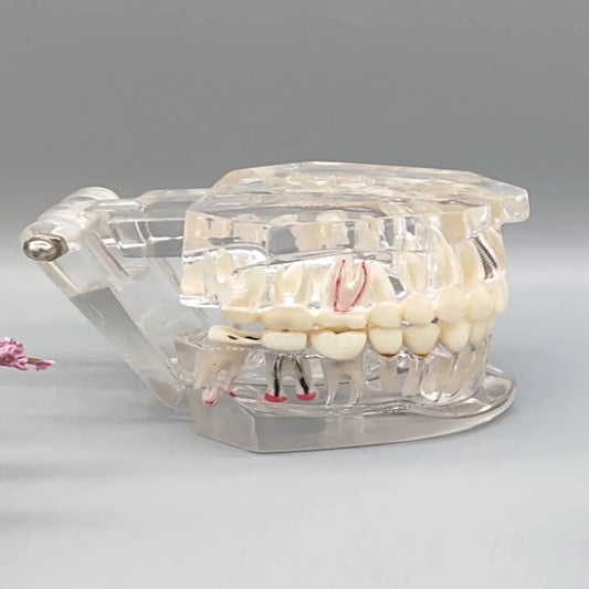Transparent Pathological Tooth Model - Dental Mates